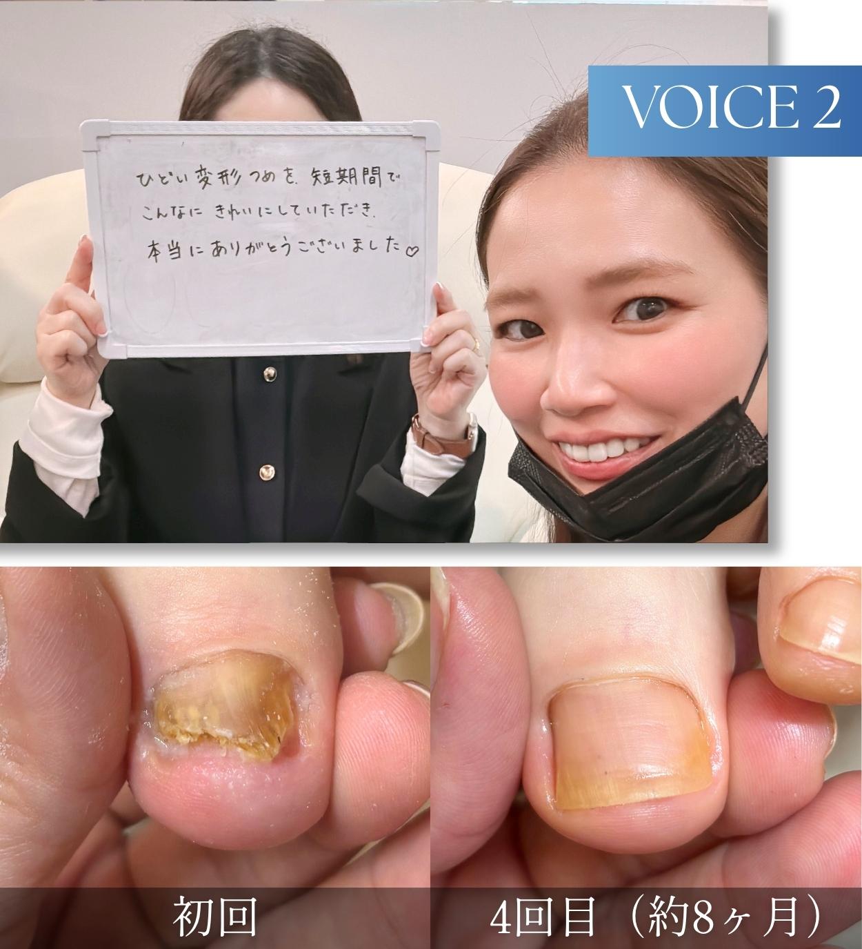 巻き爪で悩んでいたお客様の声2